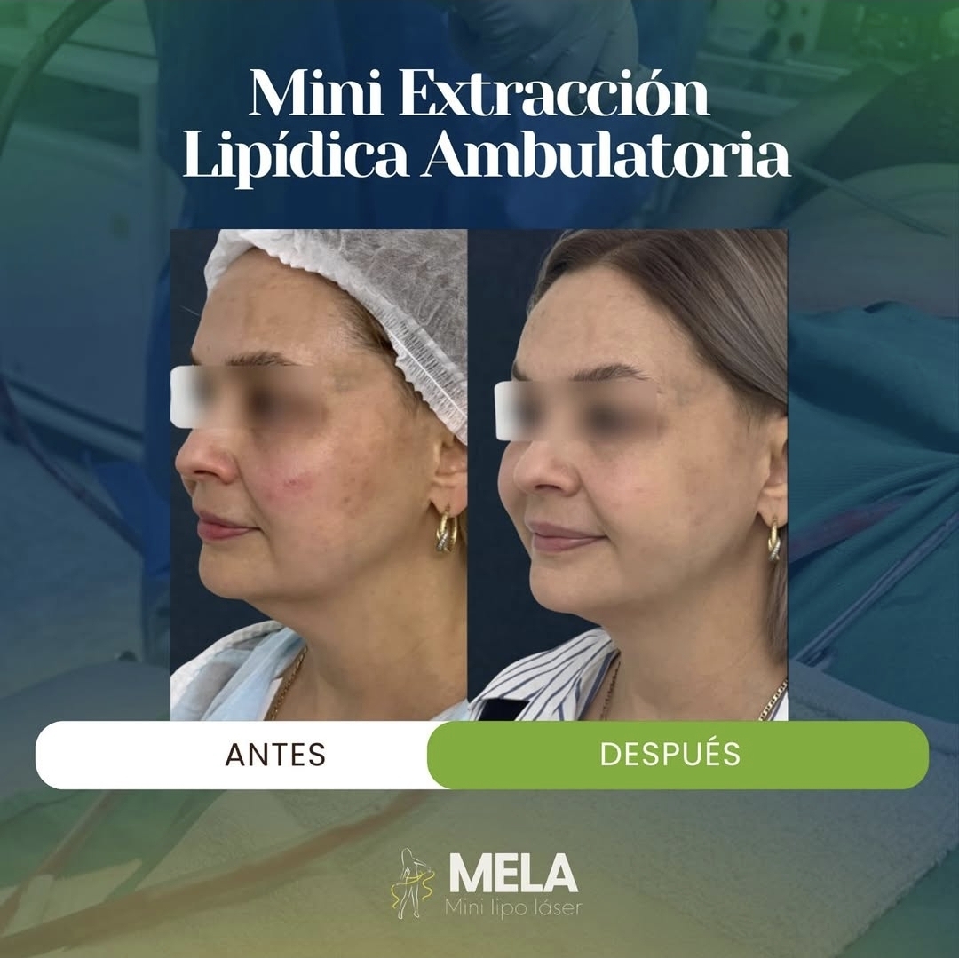 Antes y después de tratamiento dermatológico